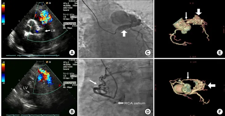 Fig.  1.  2D-Echocardiography  shows  a  dilated  left  main  coronary  artery  and  abnormal  color  flow  at  the  pulmonary  valve  level  (A)  and  mid- mid-ventricle  level  (B)