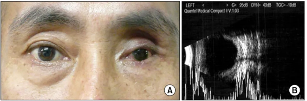Fig.  3.  Findings  at  4  months  after  operation.  (A)  Deep  sulcus  at  the  upper  lid  was  shown  due  to   atro-phic  change