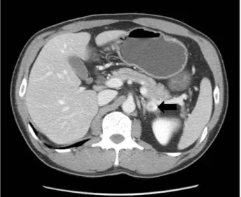Fig.  1.  Enhanced  computed  tomography  showing  a  1.3  cm  left  adrenal  mass,  4  years  after  a  right  radical  nephrectomy.