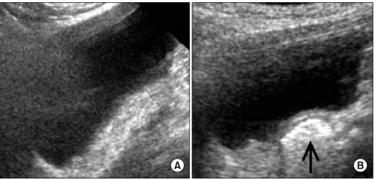Fig.  1.  Sonographic  finding  of  the  urinary  bladder.  (A)  No  specific   echo-genic  was  noted  at  the  right  ureteral  orifice  on  preoperative  sonography