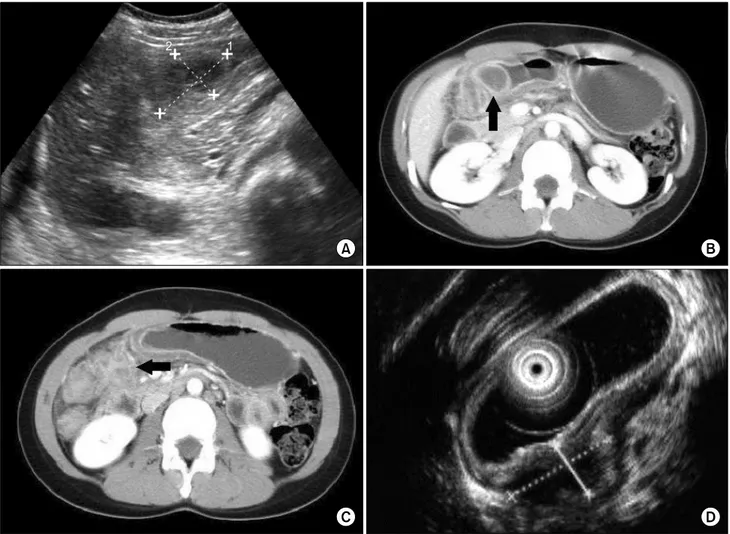 Fig.  1.  (A)  There  is  hypoechoic  mass  (about  3.0×4.0  cm)  on  the  gastric  antrum  in  transabdominal  ultrasonogarphy