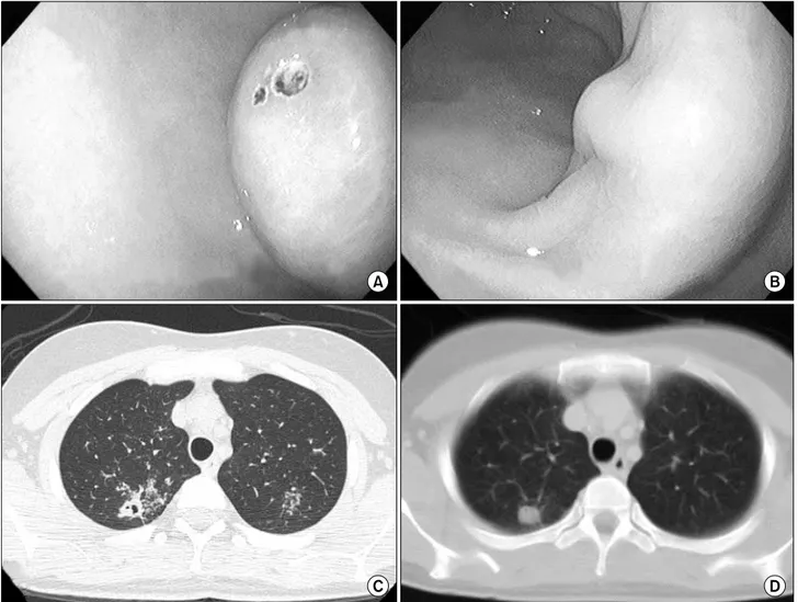 Fig.  2.  Endoscopic  findings  of  stomach  (A&amp;B).  (A)  Initial  finding  shows  a  submucosal  tumor  with  intact  overlying  mucosa  and  central  ulceration at  the  posterior  wall  of  antrum