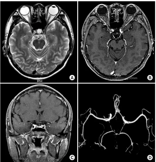Fig.  1.  Initial  brain  MRI  findings  at  the  level  of  the  brain  stem  and  CT angiography  on  the  first  visit