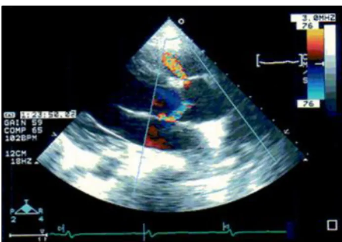 Fig.  1.  On  presentation,  trans-thoracic  echocardiography  showed  a subarterial  ventricular  septal  defect  of  3  mm  diameter  from  parasternal  long  axis  view.