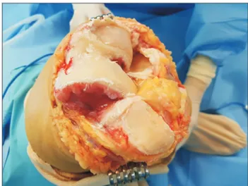 Fig. 2. We used a 3.5-mm drill to drill the patella via the fat pad under 