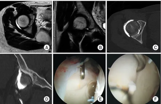 Fig. 3. There was no abnormal finding  on the cartilage of the acetabulum in  magnetic resonance imaging (A, B) nor  in computer tomography arthrography  (C, D)