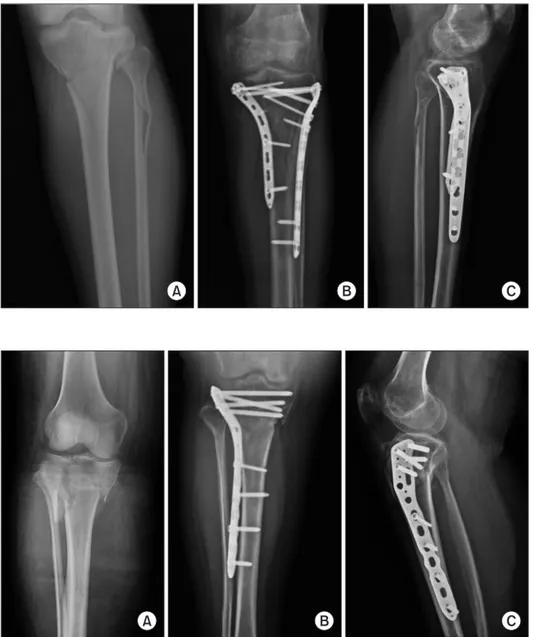 Fig. 1. (A) Preoperative radiograph showing  left tibial plateau fracture in a 36-year-old  male patient