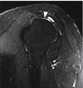 Table 2. Defect Measurement and Location of Graft Failure as Seen on MRI for Each Patient Patient no.