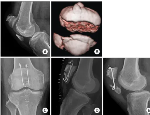 Fig. 3. Preoperative radiograph (A) and  three-dimensional computed tomographic  scan (B) of a 78-year-old male showing  comminuted patellar fracture (AO/ASIF  classification, 34–C3 type)