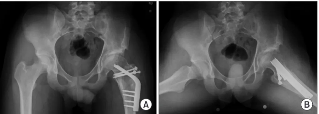 Fig. 4. A patient underwent a neck lengthening osteotomy with lateral and distal transfer of the greater trochanter performed through an anterolateral  approach