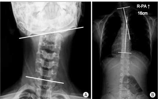 Fig. 1. (A) The cervicomandibular angle (CMA) was measured on the anteroposterior radiograph of the cervical spine to quantify the degree of head tilt