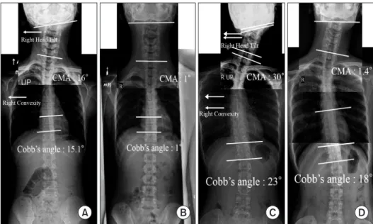 Fig. 2. An anteroposterior radiograph of the cervical spine was attached to a posteroanterior radiograph of the whole spine to show the coronal  deformity of the axial skeletal structure not only with scoliosis but also with head tilt