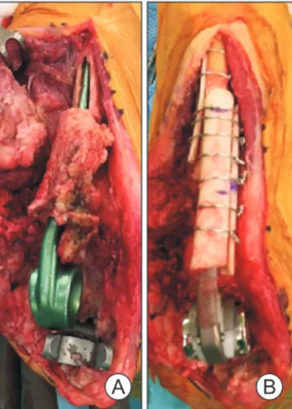 Fig. 3. (A, B) Strut graft augmentation is typically required after nonviable  bone extraction