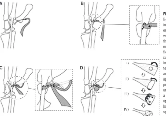 Fig. 1. Schema showing our modified  ligament reconstruction and tendon  interposition arthroplasty