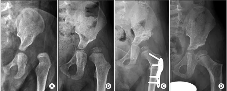 Fig. 3. Case 5, treated by open reduction and osteotomy. (A) Initial radiograph of a 9-month-old male patient, showing left hip dislocation of Tönnis  grade 2