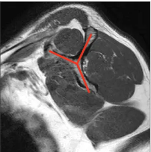 Fig. 1. Scapular Y-view. In the magnetic resonance imaging oblique  sagittal view of the shoulder, the surface where the scapula and spine  form a Y-shape is referred to as the scapular Y-view.