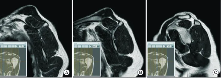 Fig. 4. Three-slice levels in a shoulder magnetic resonance imaging oblique sagittal view