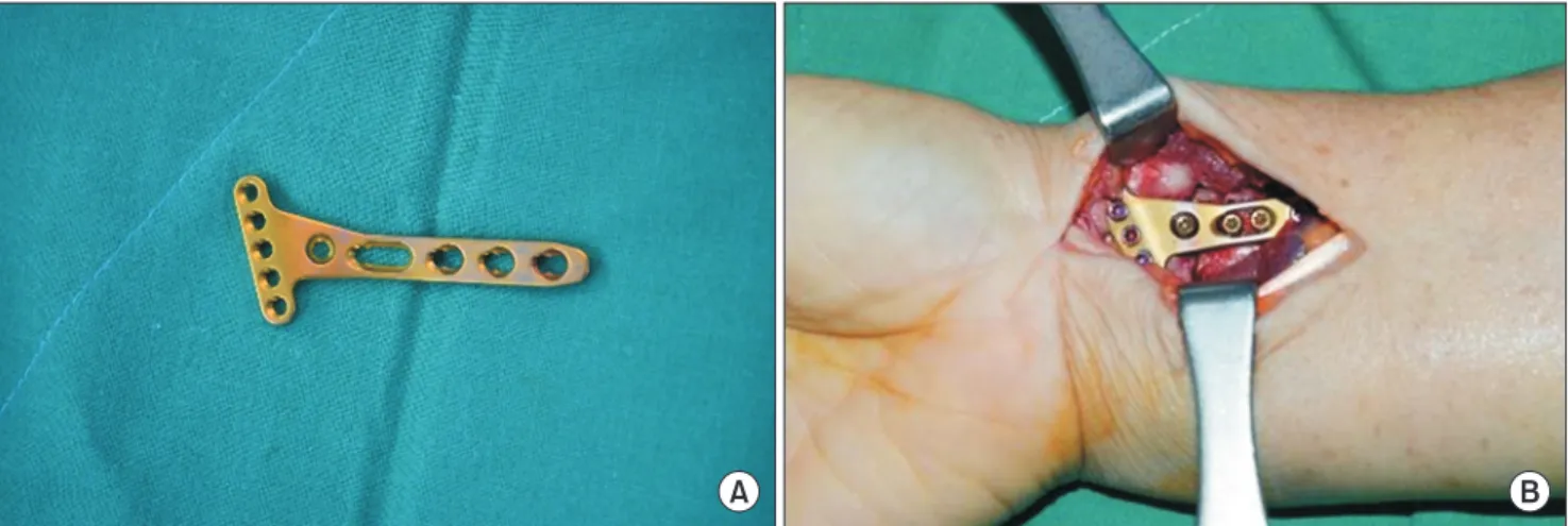 Fig. 1. Juxta-articular volar plate (A) and clinical application in a distal radius fracture (B).