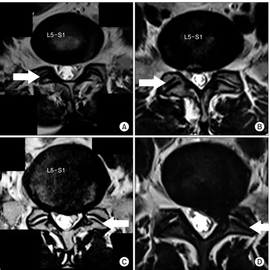 Fig. 1. Axial cut magnetic resonance  images at the affected lumbar disc levels  of different patients (arrows indicate  the side which was graded)