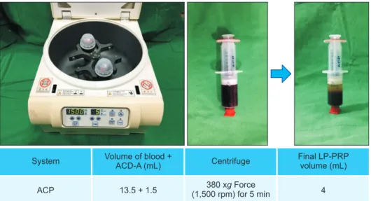 Fig. 1. Leukocyte-poor platelet-rich  plasma (LP-PRP) Arthrex ACP platelet  separation system