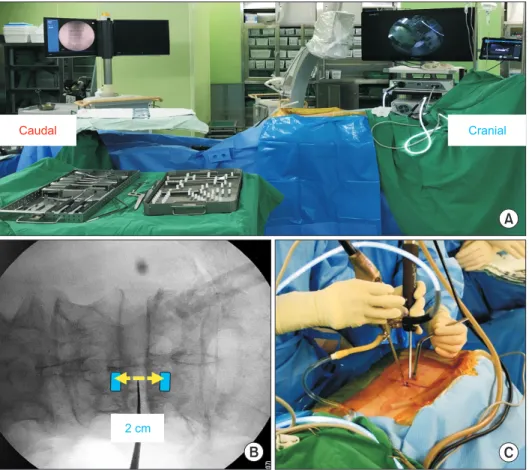Fig. 3. (A) Setup for unilateral biportal endo- endo-scopic decompression surgery. (B)  Loca-tions of viewing (upper) and working  (lo wer) portals