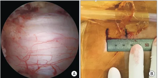 Fig. 4. (A) Intraoperative endoscopic ima- ima-ge showing decompression of the cen  tral  canal and ipsilateral laminotomy