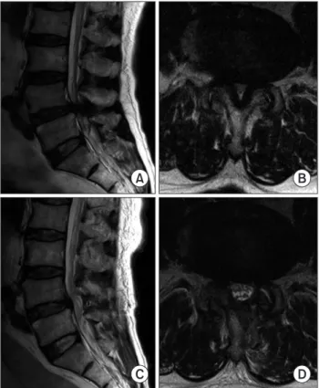 Fig. 6. Preoperative (A, B) and postoperative (C, D) T2-weighted magnetic  resonance imaging scans obtained in a patient who underwent L4–5  decompression.