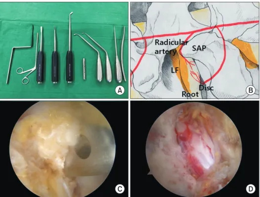 Fig. 2. (A) Surgical instruments used  during surgery. Root retractor, pituitary  forceps, three chisels with various  angles, cannula for water outflow, curved  and straight curettes, and a dilator (from  left to right)