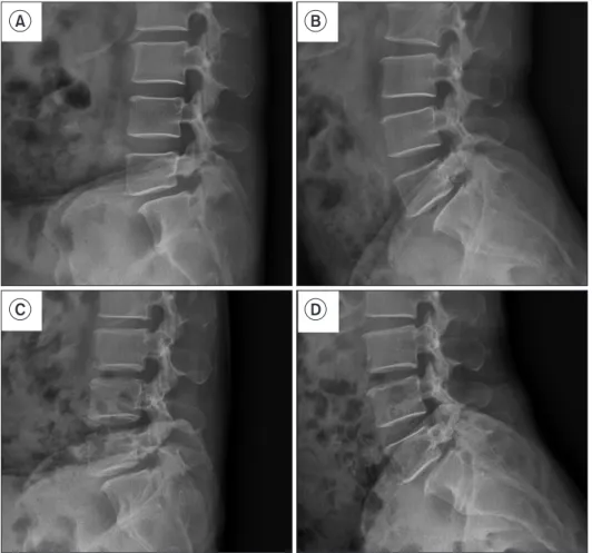 Fig. 6. A case with spondylolytic spon- spon-dylolisthesis with foraminal stenosis. 
