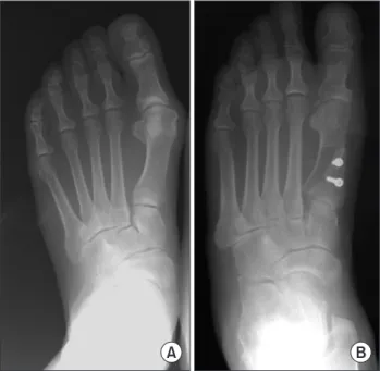 Fig. 3. Lateral view of the foot after two cortical screw fixations in the  modified proximal scarf osteotomy.