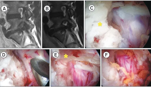 Fig. 3. A case of 53-year-old male patient with L5–S1 foraminal stenosis on the left side