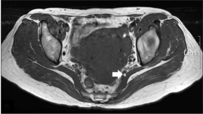 Table 4. Visual Analog Scale (VAS) at Preoperative, Immediate Postoperative, and 12 Months Follow-up