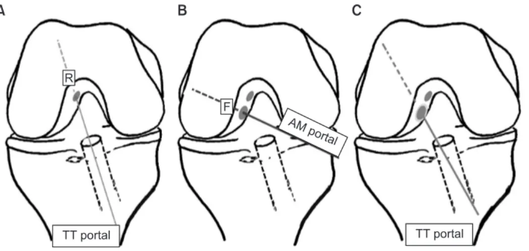 Anatomical Single-bundle Anterior Cruciate Ligament Reconstruction ...