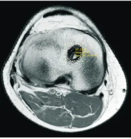 Fig. 2. Tibial bone tunnel maximum cross-sectional area was measured  automatically by picture archiving and communication system (Maroview  ver