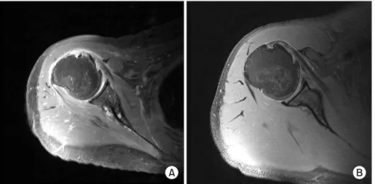 Fig. 1. T1 axial magnetic resonance  imaging scans of a 57-year-old female  patient without subluxation of the long  head of the biceps tendon (A) and a  50-year-old male patient with subluxation  (B).