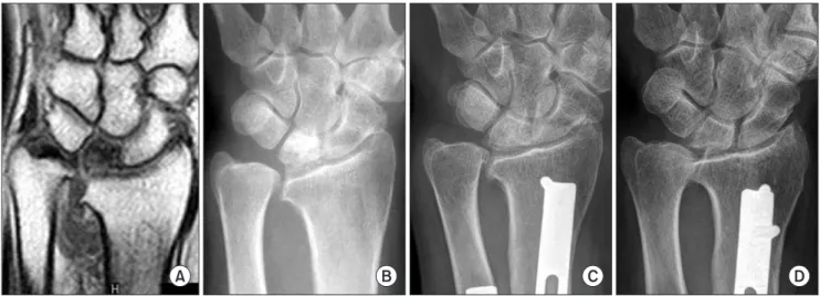 Fig. 1. The preoperative T1-weighted magnetic resonance imaging (A) and posteroanterior (PA) radiograph (B) of a 51-year-old woman show stage IIIA  Kienböck's disease in the left wrist