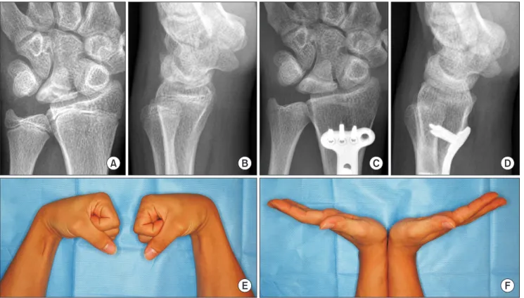 Fig. 2. The preoperative posteroanterior (PA) radiograph (A) and lateral radiograph (B) of a 15-year-old man show stage IIIB Kienböck's disease in the  left wrist