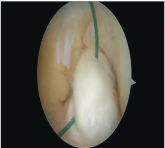 Fig. 3. After confirmation of the graft passage, the suture was tied with a  TightRope device over the button