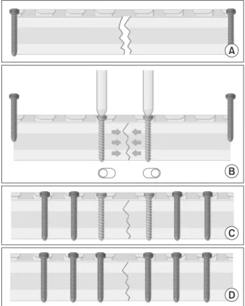 Fig. 1. Minimally invasive plate osteosynthesis using a screw compression  method. (A) A proper bone alignment is achieved using two locking  screws