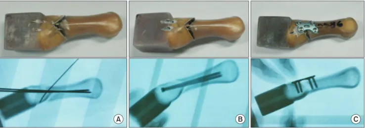 Fig. 1. Fixation constructs for three groups. (A) Group I: K-wires (1.6 mm × 2). (B) Group II: headless cannulated screws (3.0 mm × 2)