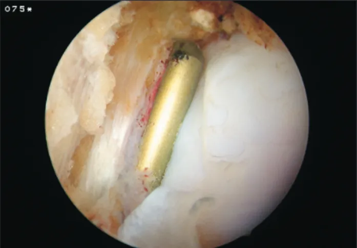 Fig. 5. Intraoperative arthroscopic view of the retained EndoButton  (Smith &amp; Nephew)