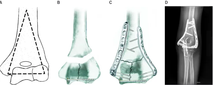 Fig. 1. (A) Schematic illustration demonstrates that distal humerus is composed of lateral and medial columns with the trochlea situated between  these columns to form a triangular construct