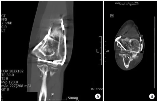 Table 2. Functional and Radiological Results of Bicolumn Restoration with Triangular Fixation 