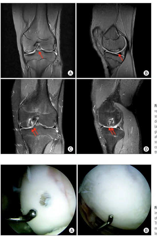 Fig. 4. (A) The preoperative arthroscopic  image shows bioabsorbable screw fixation  of the osteochondritis dissecans lesion