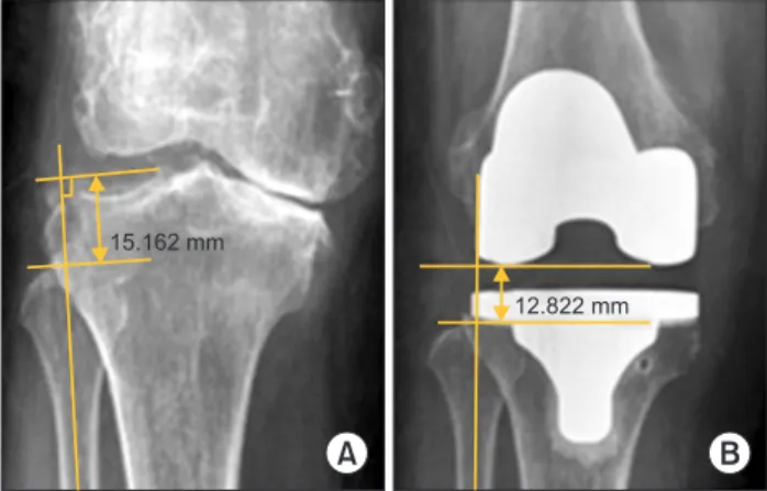 Fig. 1. (A) The preoperative joint line was defined as a line through the  midpoint of the lateral knee joint gap along the perpendicular line to the  long axis of the fibula