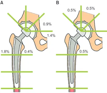 Fig. 5. Incidence of osteolysis in hips with interface bioactive bone  cement (IBBC) technique (A) and non-IBBC technique (B) in the second  stage.A B6% 47% 18% 59%71%89%30%23%6%12%6%
