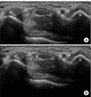 Fig. 1. (A) Transverse image of the median nerve at the proximal inlet of  the carpal tunnel