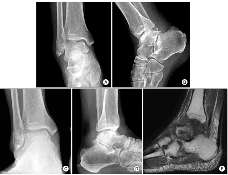 Fig. 1. (A) Frontal view of the ankle at initial presentation in the accident and emergency department