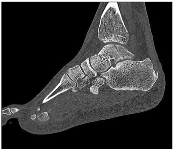 Fig. 4. Sagittal computed tomography demonstrating a coronal shearing  body fracture of the talus with secondary arthritic change of the subtalar  joint.