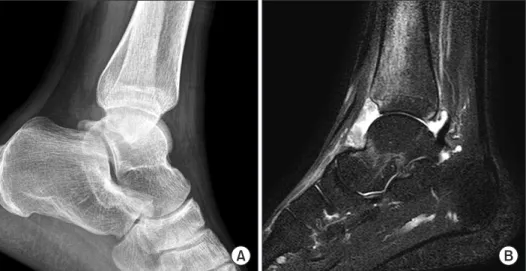 Fig. 6. (A) Lateral view of the ankle,  showing a minimally displaced talar neck  fracture, 4 months after the injury